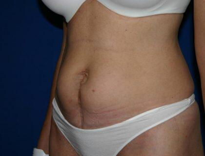 Tummy Tuck Before & After Image