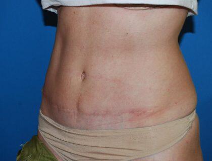 Tummy Tuck Before & After Image