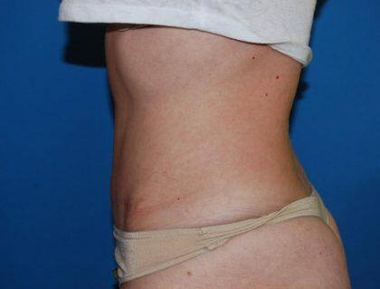 Tummy Tuck Before & After Image