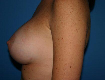 Breast Augmentation Before & After Image