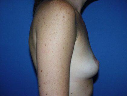 Breast Augmentation Before & After Image