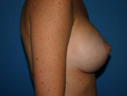 Breast Augmentation Before & After Image