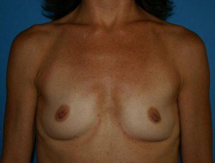 Breast Augmentation Before & After Image