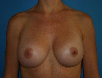 Breast Augmentation Before & After Image