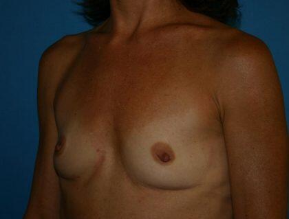 Breast Augmentation Before & After Image