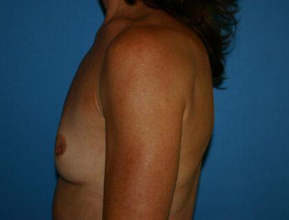 Breast Augmentation Before & After Image