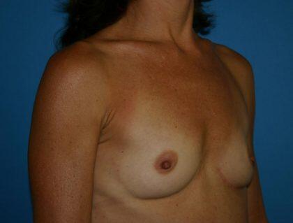 Breast Augmentation Before & After Image