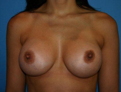 Breast Augmentation Before & After Image