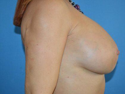 Breast Augmentation Before & After Image