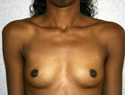 Breast Augmentation Before & After Image