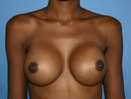 Breast Augmentation Before & After Image