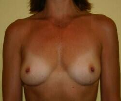 Breast Augmentation Before & After Image