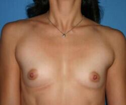 Breast Augmentation Before & After Image