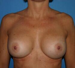 Breast Augmentation Before & After Image