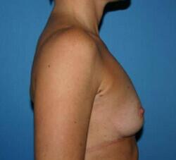 Breast Augmentation Before & After Image