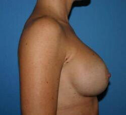 Breast Augmentation Before & After Image