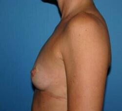 Breast Augmentation Before & After Image