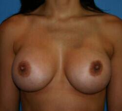 Breast Augmentation Before & After Image