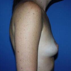 Breast Augmentation Before & After Image