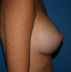 Breast Augmentation Before & After Image