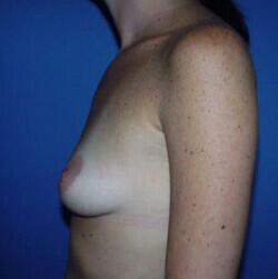 Breast Augmentation Before & After Image