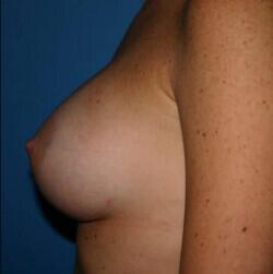 Breast Augmentation Before & After Image