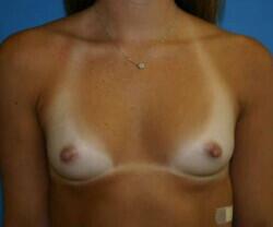 Breast Augmentation Before & After Image