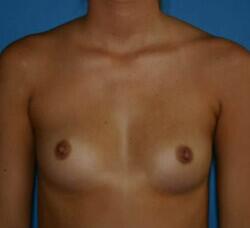 Breast Augmentation Before & After Image