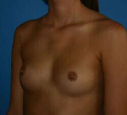 Breast Augmentation Before & After Image