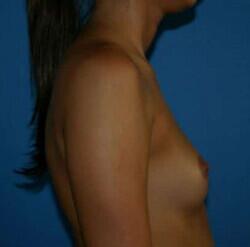 Breast Augmentation Before & After Image