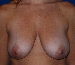 Breast Augmentation Before & After Image