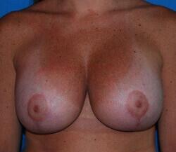 Breast Augmentation Before & After Image