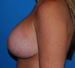 Breast Augmentation Before & After Image