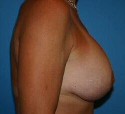 Breast Augmentation Before & After Image