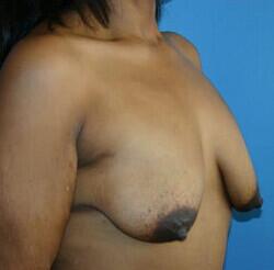 Breast Augmentation Before & After Image