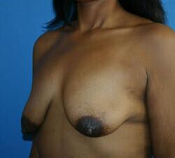 Breast Augmentation Before & After Image