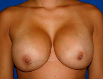 Breast Augmentation Before & After Image