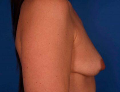 Breast Augmentation Before & After Image