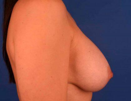 Breast Augmentation Before & After Image