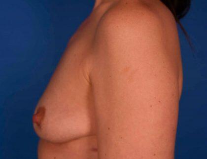 Breast Augmentation Before & After Image
