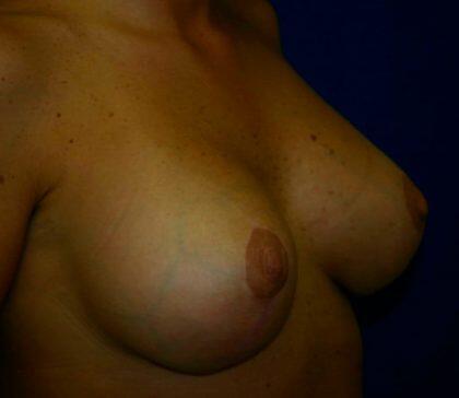 Breast Augmentation Before & After Image