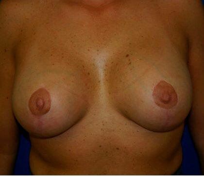 Breast Augmentation Before & After Image
