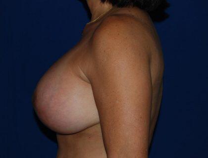 Breast Lift Before & After Image