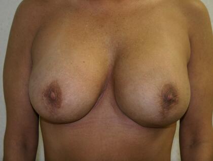 Breast Lift Before & After Image