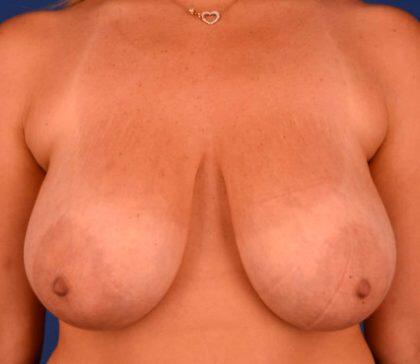 Breast Lift Before & After Image