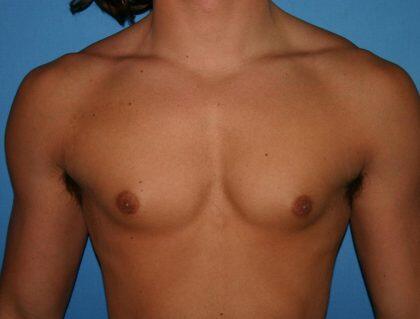 Gynecomastia Before & After Image