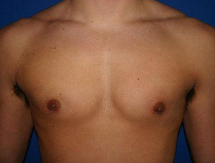 Gynecomastia Before & After Image