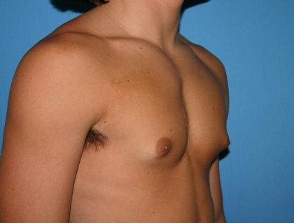 Gynecomastia Before & After Image