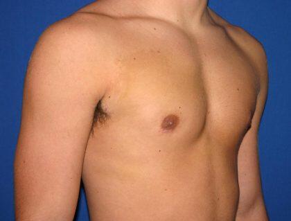 Gynecomastia Before & After Image