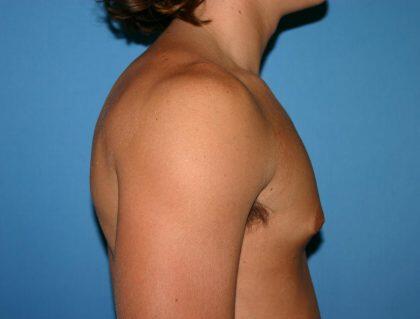 Gynecomastia Before & After Image